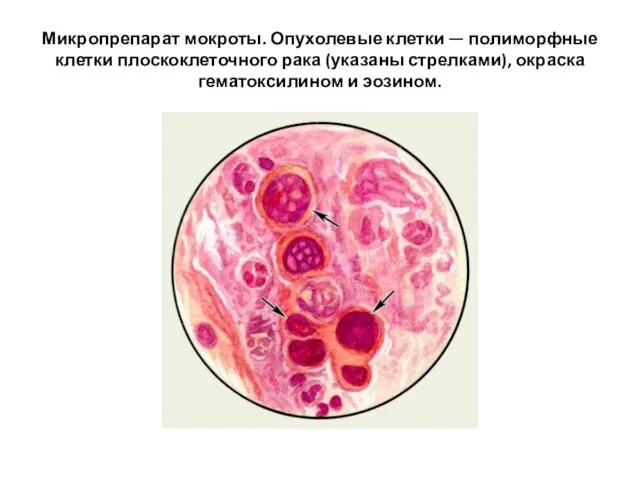 Микропрепарат мокроты. Опухолевые клетки — полиморфные клетки плоскоклеточного рака (указаны стрелками), окраска гематоксилином и эозином.