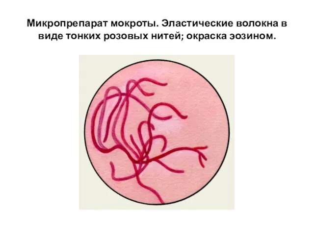 Микропрепарат мокроты. Эластические волокна в виде тонких розовых нитей; окраска эозином.