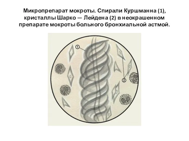 Микропрепарат мокроты. Спирали Куршманна (1), кристаллы Шарко — Лейдена (2) в