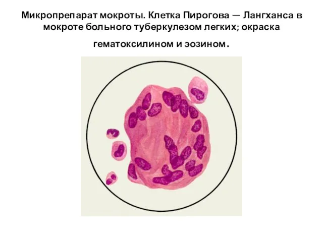 Микропрепарат мокроты. Клетка Пирогова — Лангханса в мокроте больного туберкулезом легких; окраска гематоксилином и эозином.