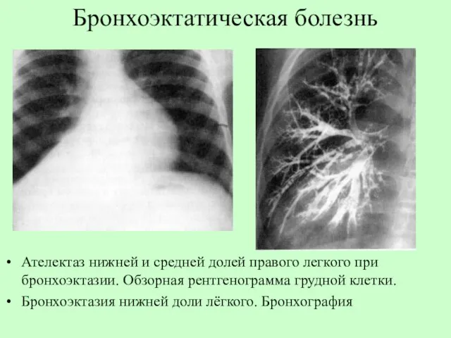 Бронхоэктатическая болезнь Ателектаз нижней и средней долей правого легкого при бронхоэктазии.