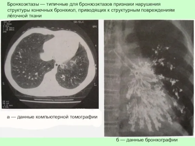 Бронхоэктазы — типичные для бронхоэктазов признаки нарушения структуры конечных бронхиол, приводящих