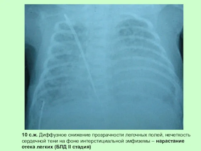 10 с.ж. Диффузное снижение прозрачности легочных полей, нечеткость сердечной тени на
