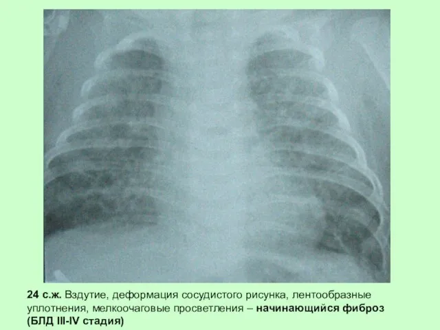 24 с.ж. Вздутие, деформация сосудистого рисунка, лентообразные уплотнения, мелкоочаговые просветления – начинающийся фиброз (БЛД III-IV стадия)