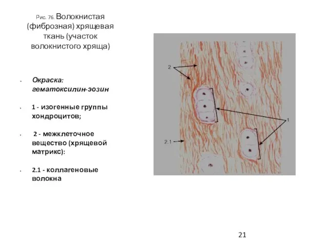 Рис. 76. Волокнистая (фиброзная) хрящевая ткань (участок волокнистого хряща) Окраска: гематоксилин-эозин