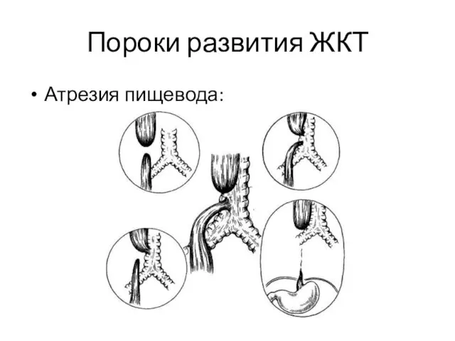 Пороки развития ЖКТ Атрезия пищевода: