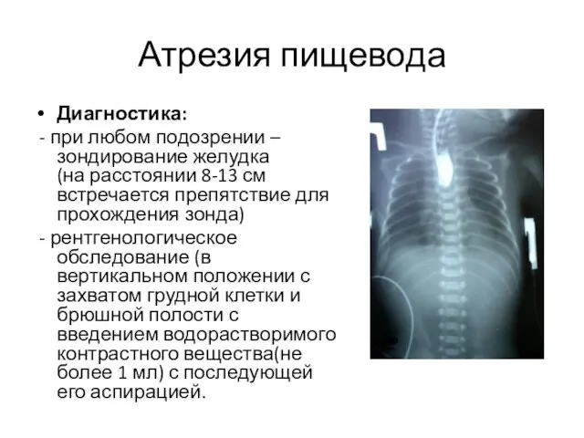 Атрезия пищевода Диагностика: - при любом подозрении – зондирование желудка (на