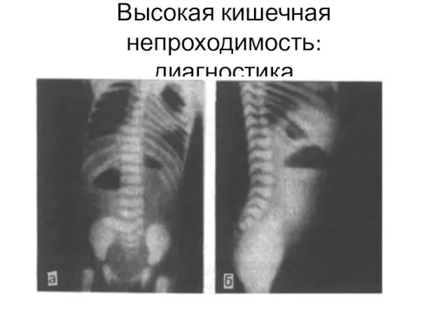 Высокая кишечная непроходимость: диагностика