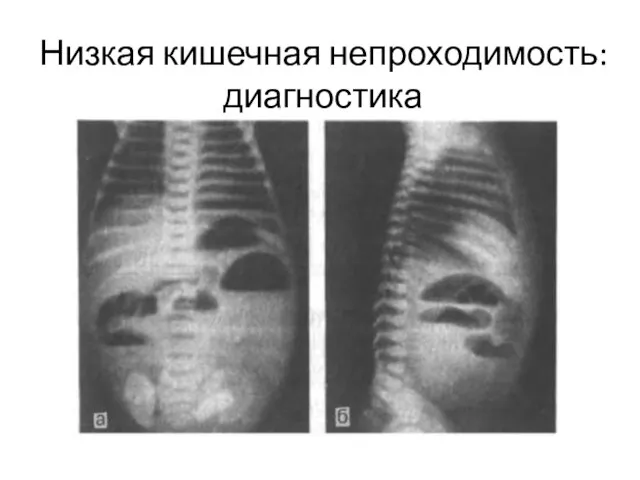 Низкая кишечная непроходимость: диагностика