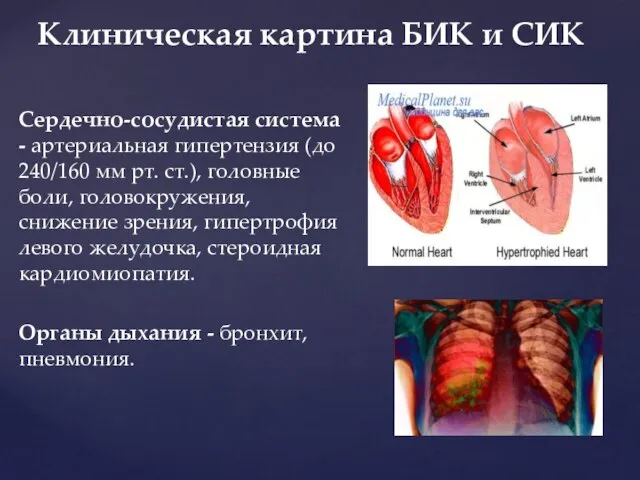 Сердечно-сосудистая система - артериальная гипертензия (до 240/160 мм рт. ст.), головные