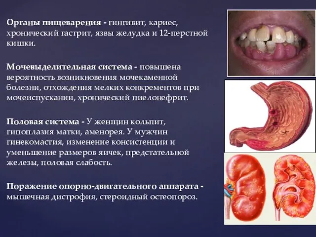 Органы пищеварения - гингивит, кариес, хронический гастрит, язвы желудка и 12-перстной