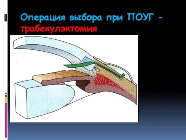 Операция выбора при ПОУГ - трабекулэктомия