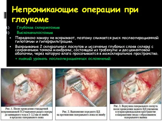 Непроникающие операции при глаукоме Глубокая склерэктомия Вискоканалостомия Переднюю камеру не вскрывают,