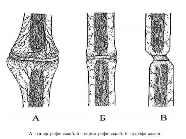 А – гипертрофический; Б – нормотрофический; В – атрофический.