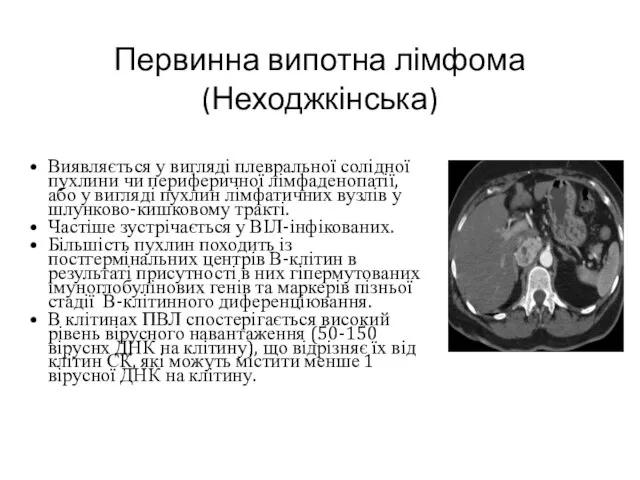 Первинна випотна лімфома (Неходжкінська) Виявляється у вигляді плевральної солідної пухлини чи