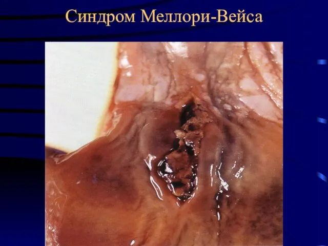 Синдром Меллори-Вейса