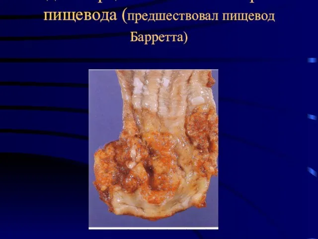 Аденокарцинома в нижней трети пищевода (предшествовал пищевод Барретта)