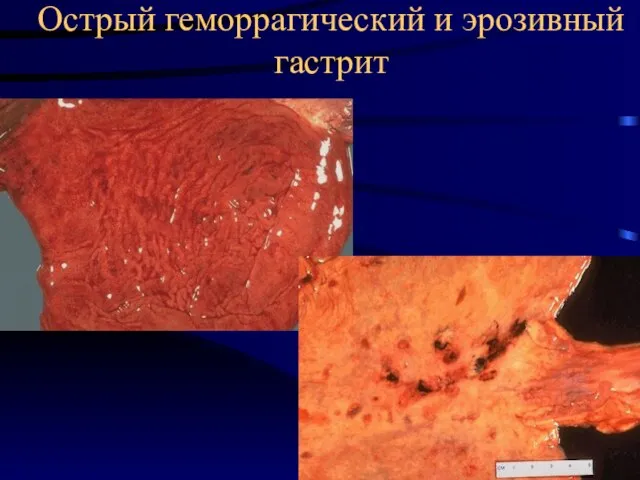 Острый геморрагический и эрозивный гастрит