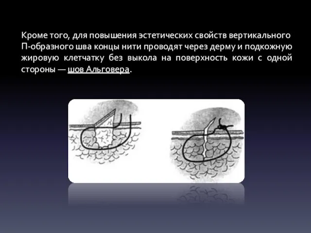 Кроме того, для повышения эстетических свойств вертикального П-образного шва концы нити