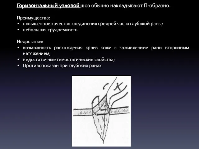 Горизонтальный узловой шов обычно накладывают П-образно. Преимущества: повышенное качество соединения средней