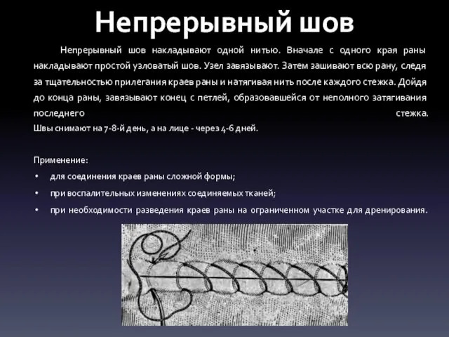 Непрерывный шов Непрерывный шов накладывают одной нитью. Вначале с одного края