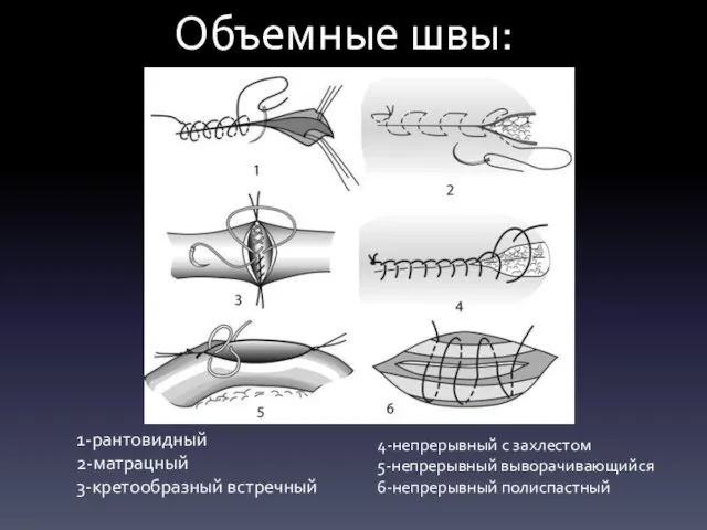 Объемные швы: 1-рантовидный 2-матрацный 3-кретообразный встречный 4-непрерывный с захлестом 5-непрерывный выворачивающийся 6-непрерывный полиспастный