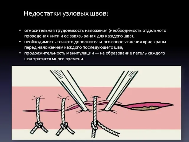 Недостатки узловых швов: относительная трудоемкость наложения (необходимость отдельного проведения нити и