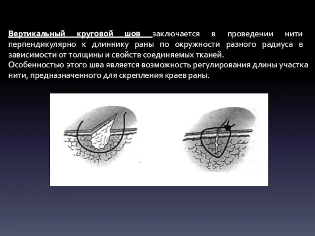 Вертикальный круговой шов заключается в проведении нити перпендикулярно к длиннику раны