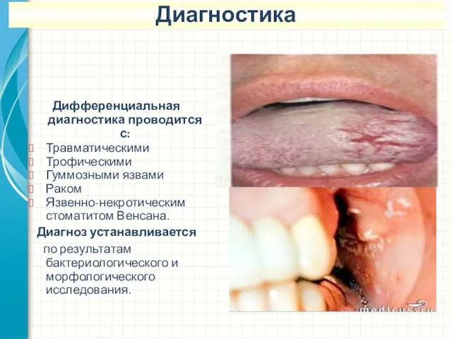 Дифференциальная диагностика проводится с: Травматическими Трофическими Гуммозными язвами Раком Язвенно-некротическим стоматитом