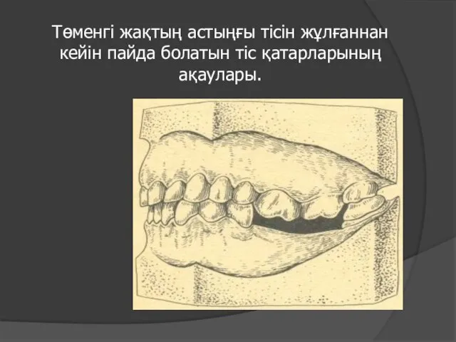 Төменгі жақтың астыңғы тісін жұлғаннан кейін пайда болатын тіс қатарларының ақаулары.