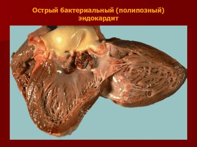 Острый бактериальный (полипозный) эндокардит