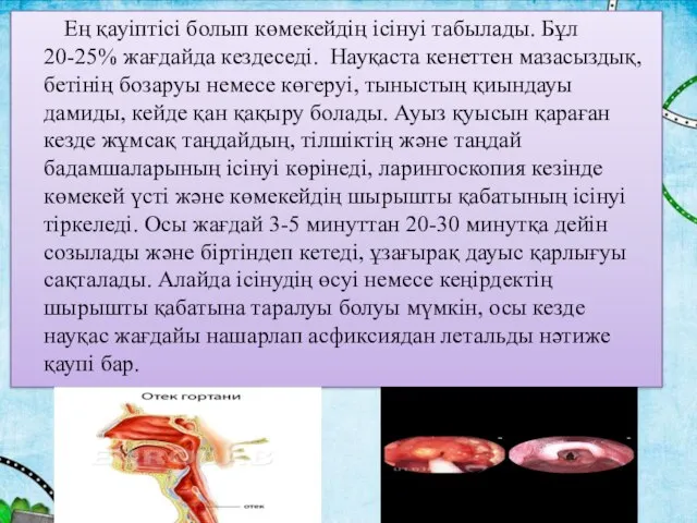 Ең қауіптісі болып көмекейдің ісінуі табылады. Бұл 20-25% жағдайда кездеседі. Науқаста