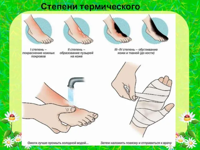 Степени термического ожога