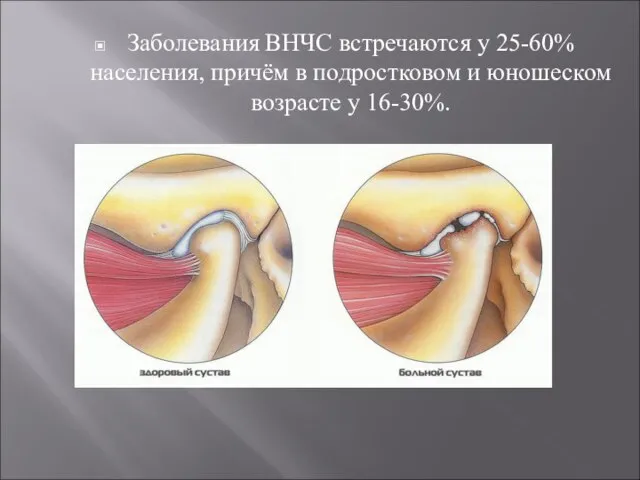 Заболевания ВНЧС встречаются у 25-60% населения, причём в подростковом и юношеском возрасте у 16-30%.