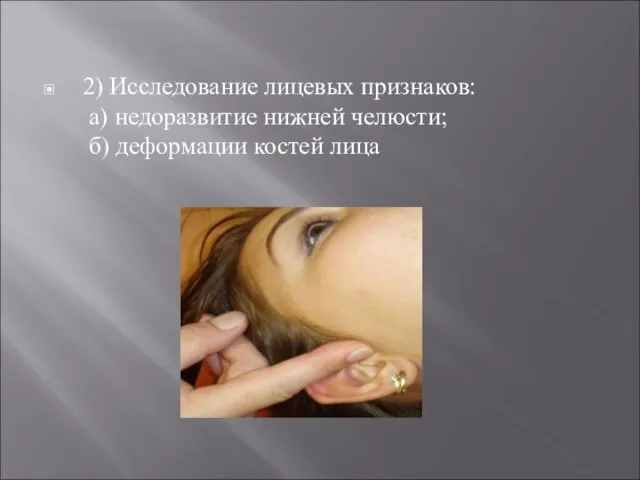 2) Исследование лицевых признаков: а) недоразвитие нижней челюсти; б) деформации костей лица