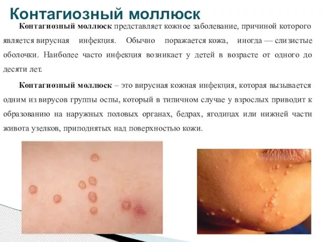 Контагиозный моллюск представляет кожное заболевание, причиной которого является вирусная инфекция. Обычно