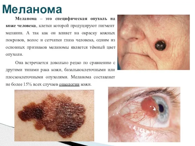 Меланома – это специфическая опухоль на коже человека, клетки которой продуцируют