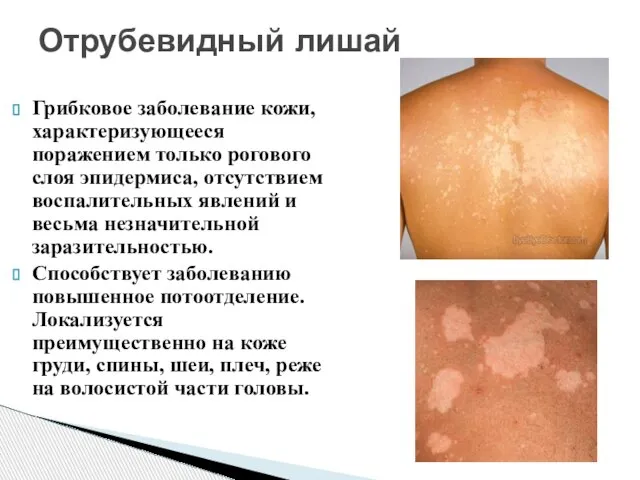 Грибковое заболевание кожи, характеризующееся поражением только рогового слоя эпидермиса, отсутствием воспалительных