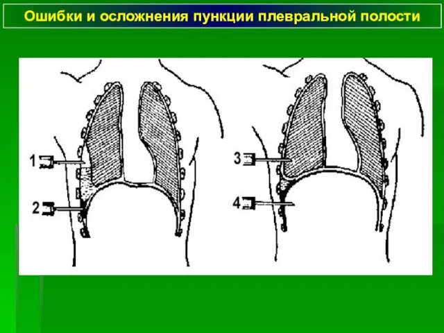 Ошибки и осложнения пункции плевральной полости