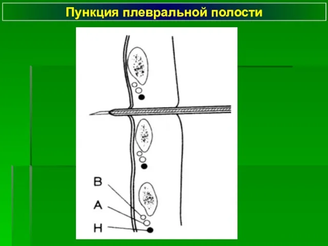 Пункция плевральной полости