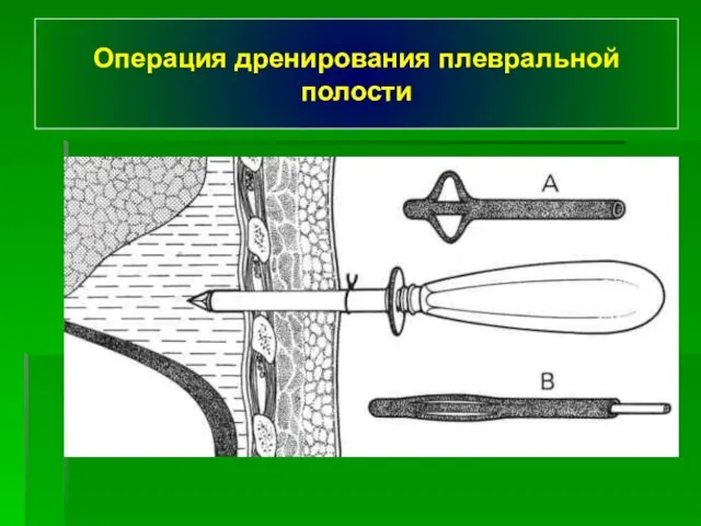 Операция дренирования плевральной полости