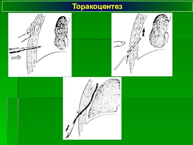 Торакоцентез