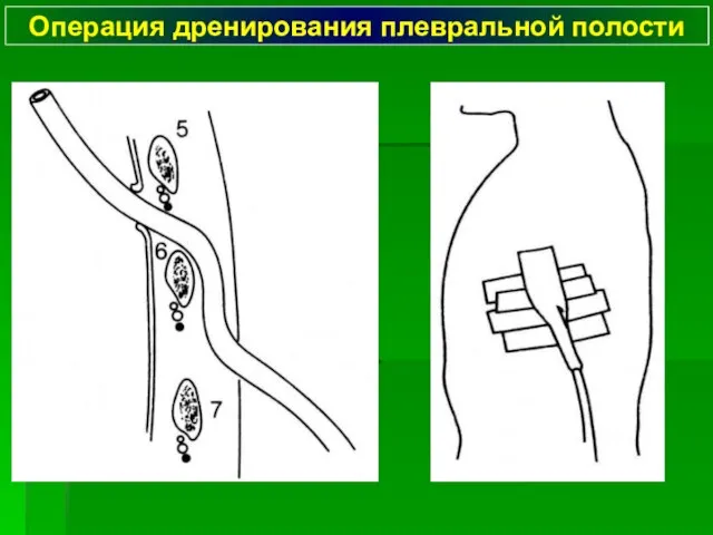 Операция дренирования плевральной полости