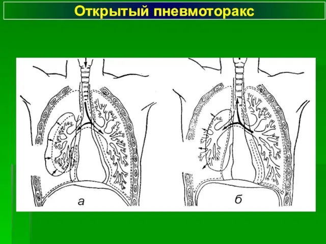 Открытый пневмоторакс