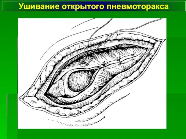 Ушивание открытого пневмоторакса