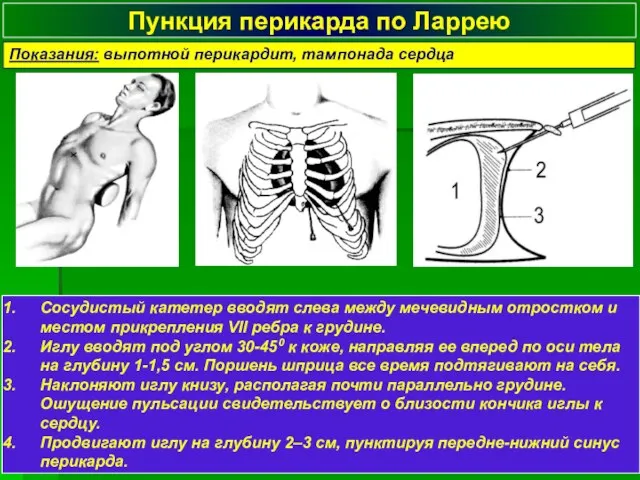 Пункция перикарда по Ларрею Сосудистый катетер вводят слева между мечевидным отростком