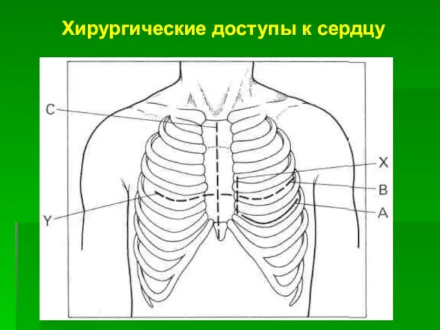 Хирургические доступы к сердцу