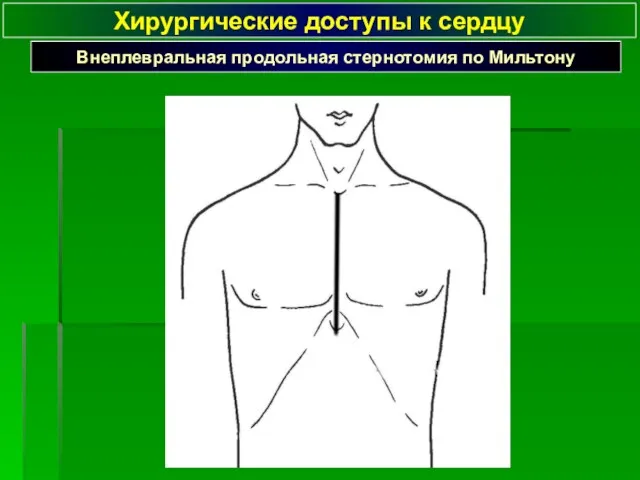 Хирургические доступы к сердцу Внеплевральная продольная стернотомия по Мильтону