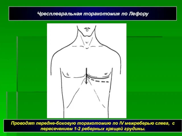 Проводят передне-боковую торакотомию по IV межреберью слева, с пересечением 1-2 реберных