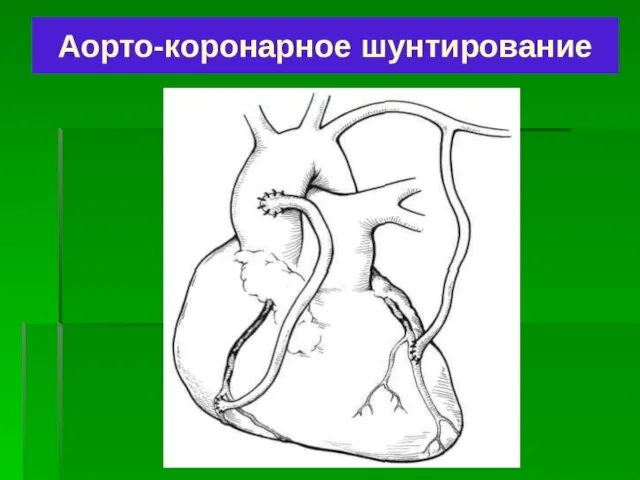 Аорто-коронарное шунтирование